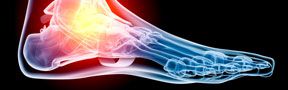 Heel and Arch Pain